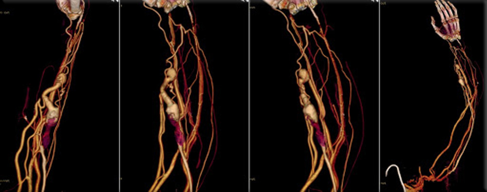 CTA (Computed Tomography Angiography) showing nice 3D rendering of the AV Hemodialysis Shunt Thrombosis (purple) in the cephalic vein with dilatation of the distal part of the cephalic vein