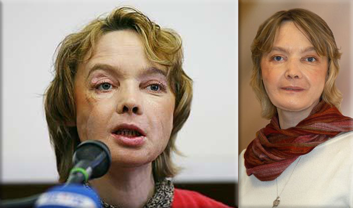 Isabelle Dinoire, pictured in 2006 almost one year after she received the world's first partial face transplant in Northern France